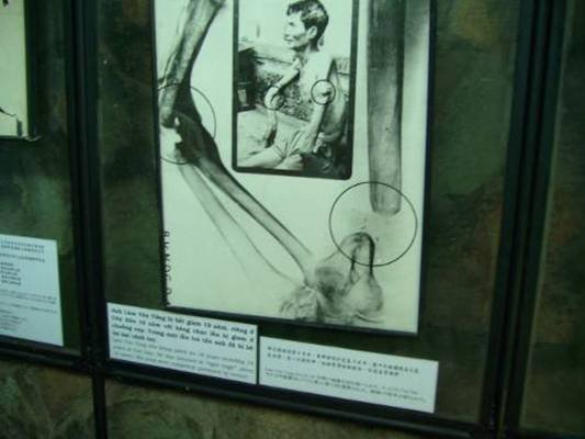 Photo: Auf grässlichste Art hat man den Gefangenen in den Gefängnissen in Vietnam damals die Knochen gebrochen